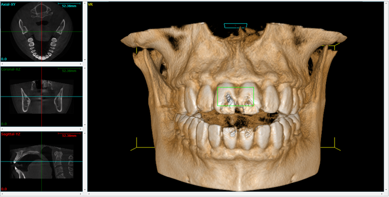 Dental TAC