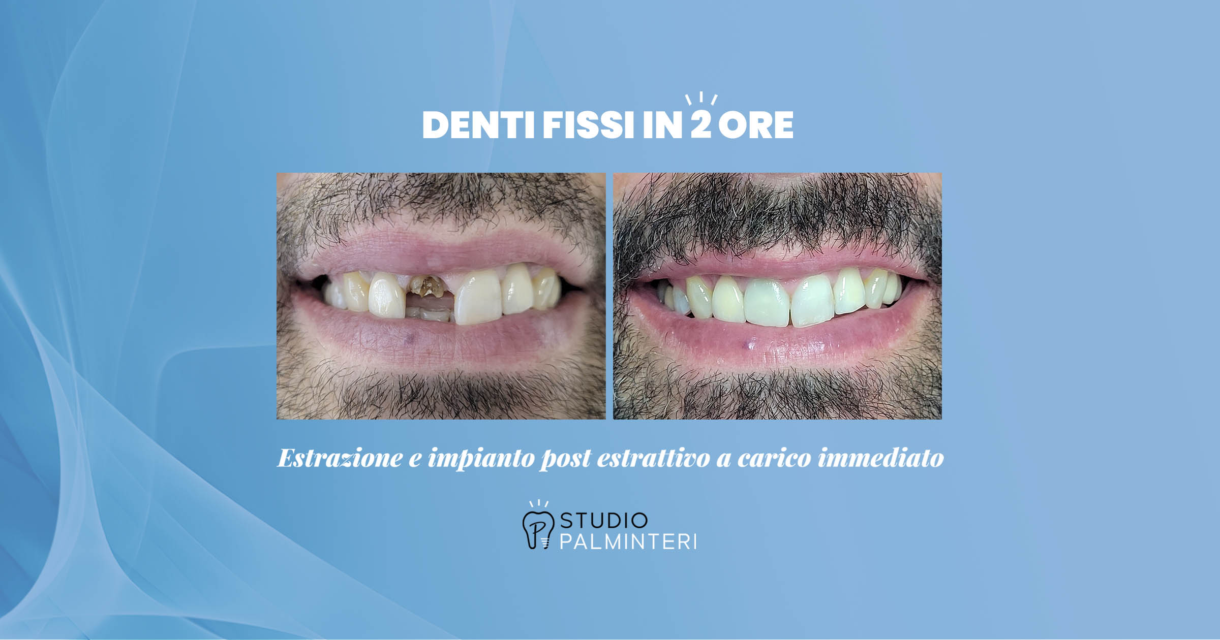 Lo Studio Dentistico Palminteri esegue a Brindisi impianti dentali post estrattivi a carico immediato di denti singoli o intere arcate.